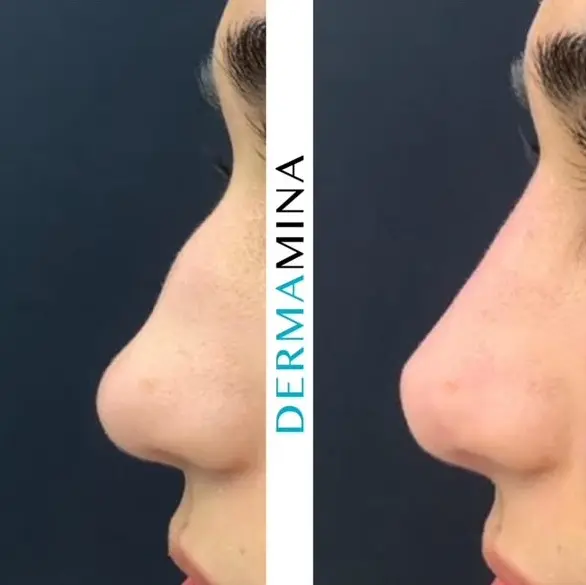 Non-surgical nose job before and after at Dermamina London, result 17