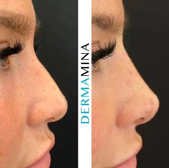 Non-surgical nose job before and after at Dermamina London, result 11