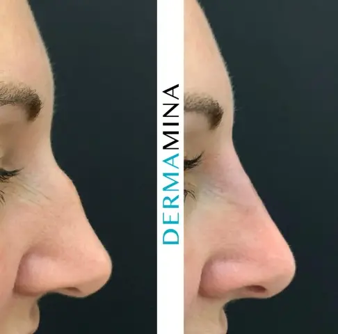 Non-surgical nose job before and after at Dermamina London, result 18