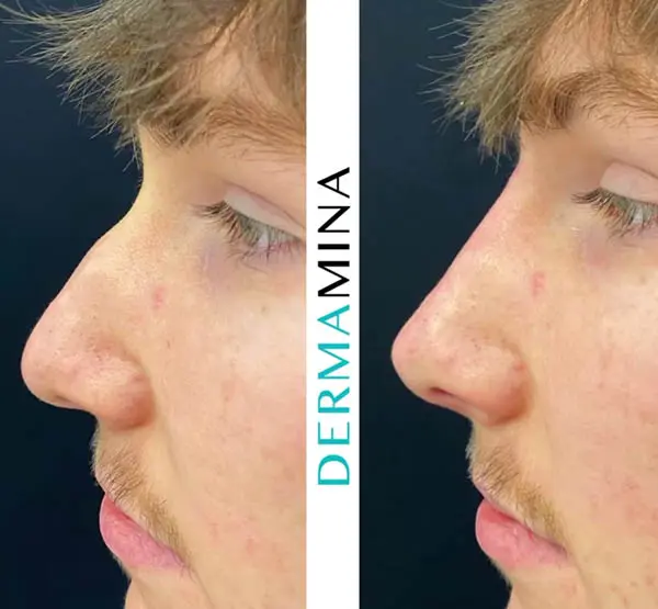 Non-surgical nose job before and after at Dermamina London, result 13
