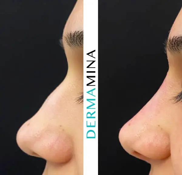 Non-surgical nose job before and after at Dermamina London, result 12