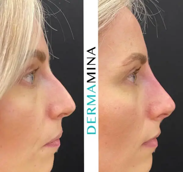 Non-surgical nose job before and after at Dermamina London, result 19