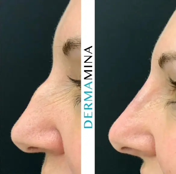 Non-surgical nose job before and after at Dermamina London, result 16
