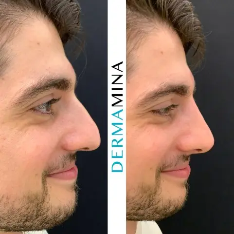 Non-surgical nose job before and after at Dermamina London, result 20