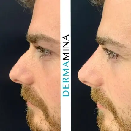 Non-surgical nose job before and after at Dermamina London, result 21