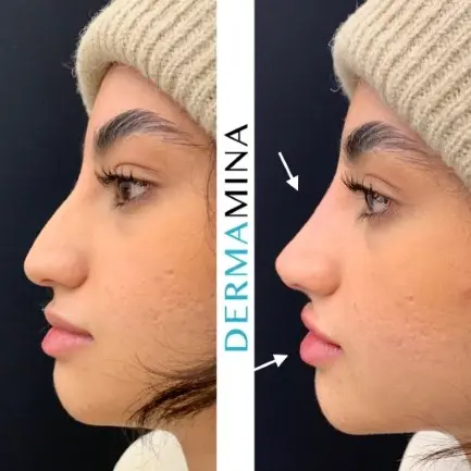 Non-surgical nose job before and after at Dermamina London, result 22