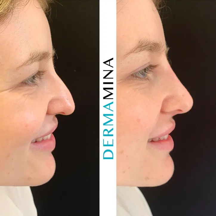 Non-surgical nose job before and after at Dermamina London, result 23