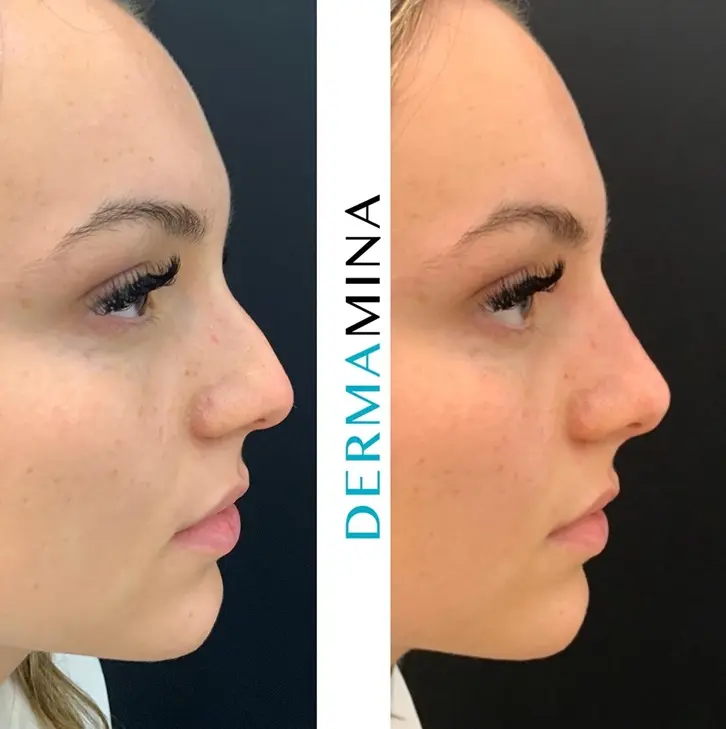 Non-surgical nose job before and after at Dermamina London, result 24
