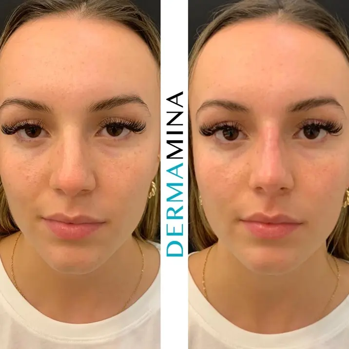 Non-surgical nose job before and after at Dermamina London, result 25