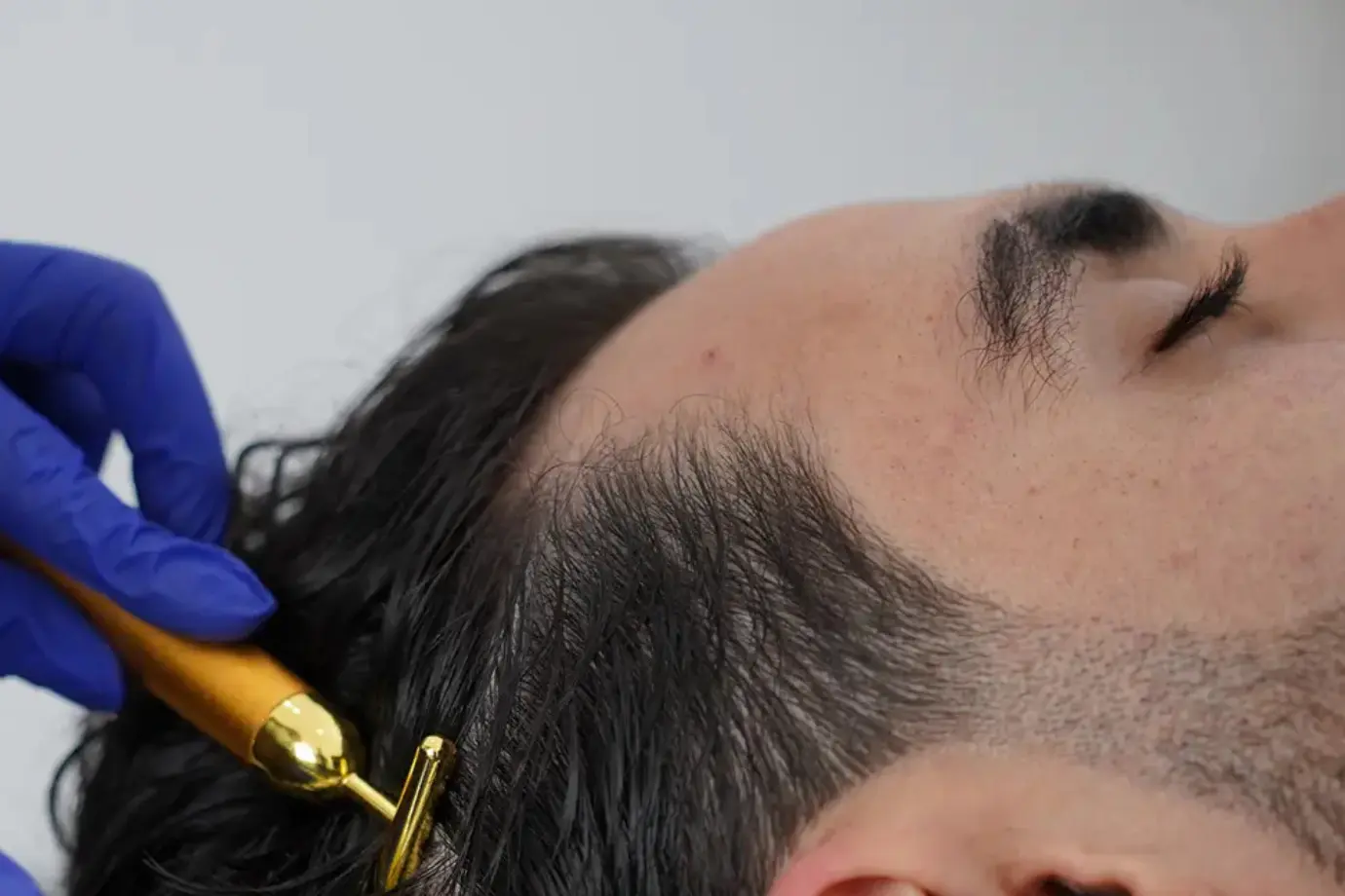 PRP Hair Restoration