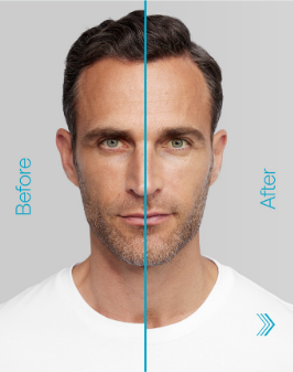 Radiesse+ Result
