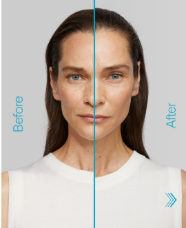 Radiesse+ Result