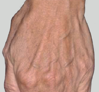 Hands Rejuvenation Before