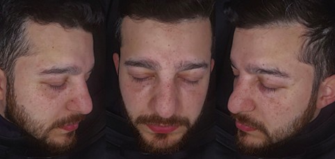 Exosomes Face Results Timeline