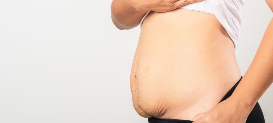 Stretch Marks