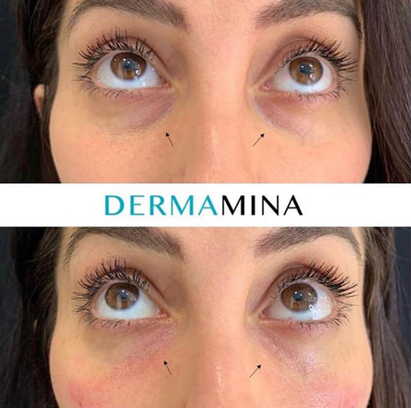 Undereye hollowness