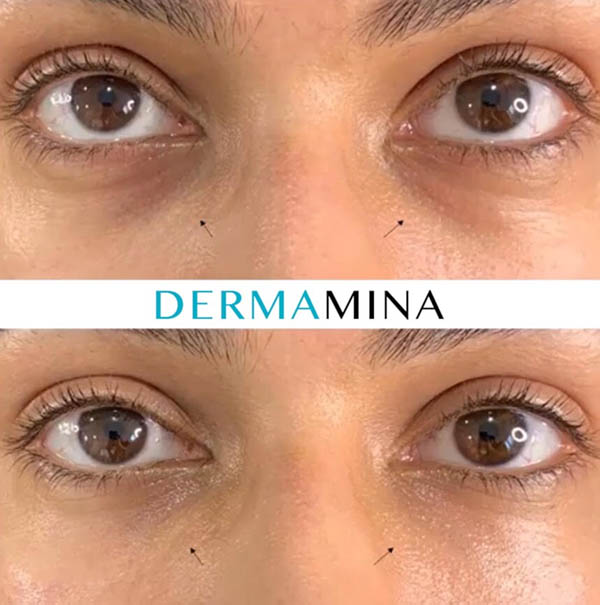 Scooped Undereye Area