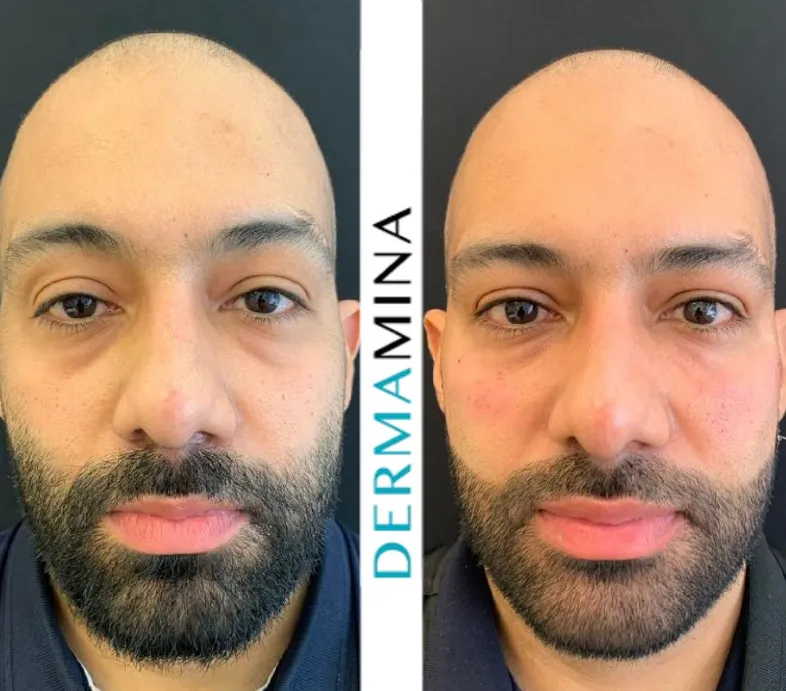 Before and After