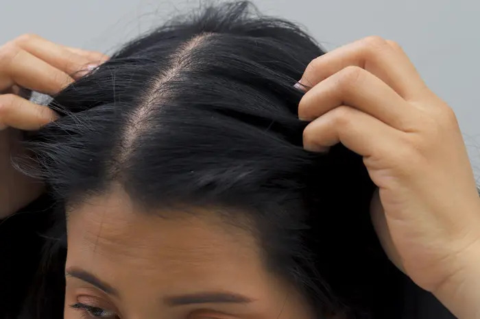 Everything About Prp For Hair Loss