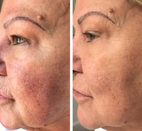 Before and After