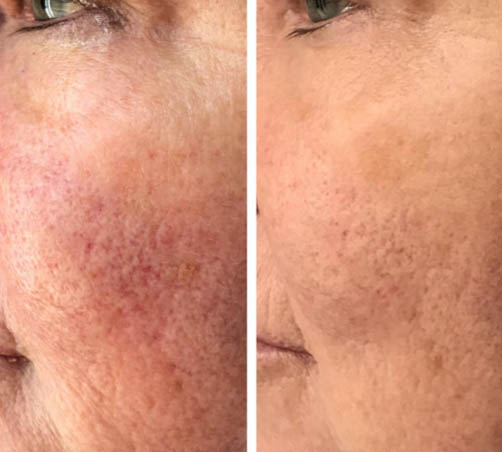 Before and After