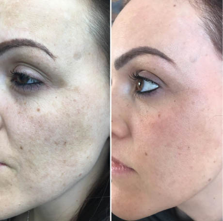 Before and After